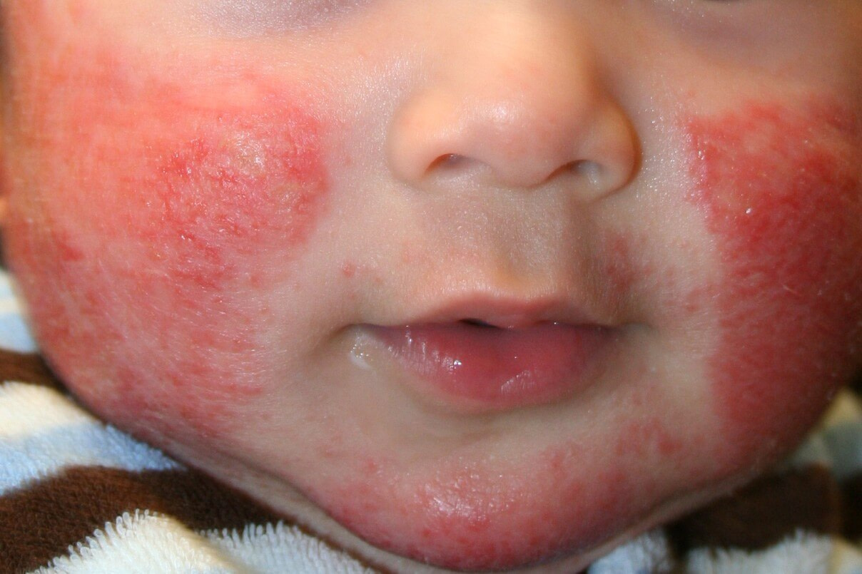 Dermatitis Atópica en la Cara bebes