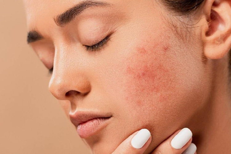 Dermatitis Atópica en la Cara